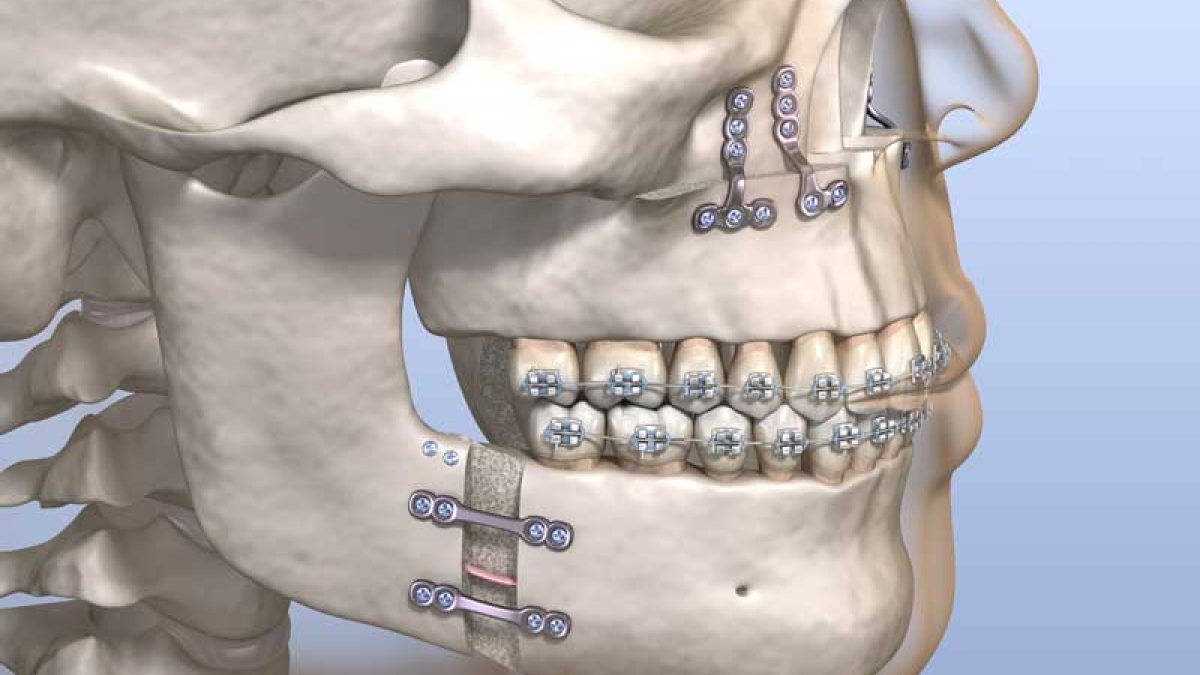 Jaw Surgery