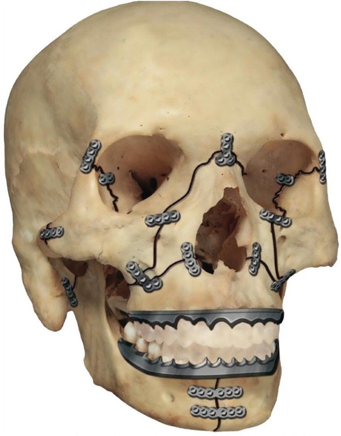 Craniofacial Surgery