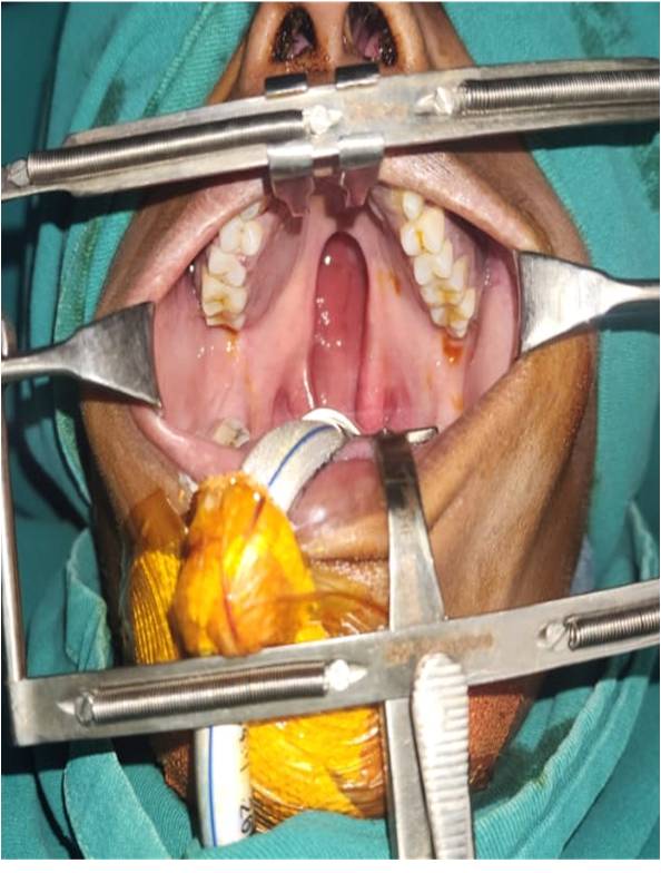 Before Veau II Soft And Hard Palate Cleft