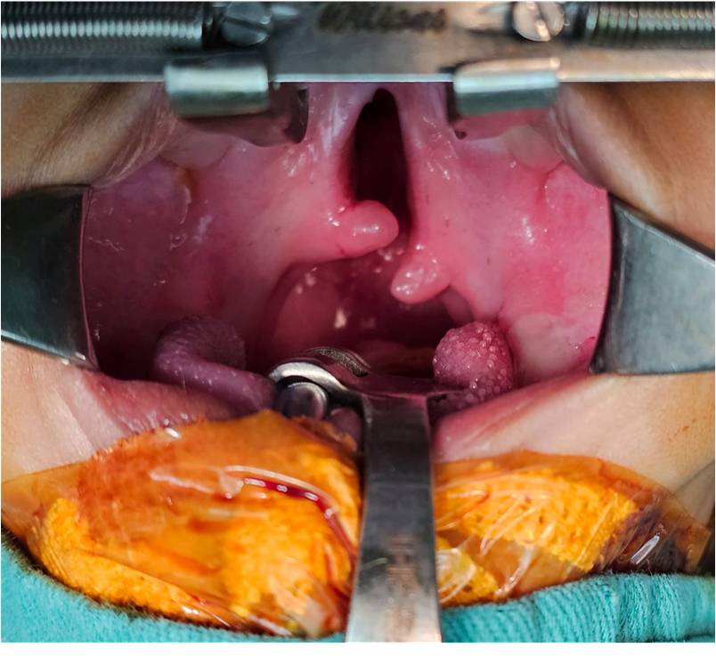 Before Veau I Soft Palate Cleft