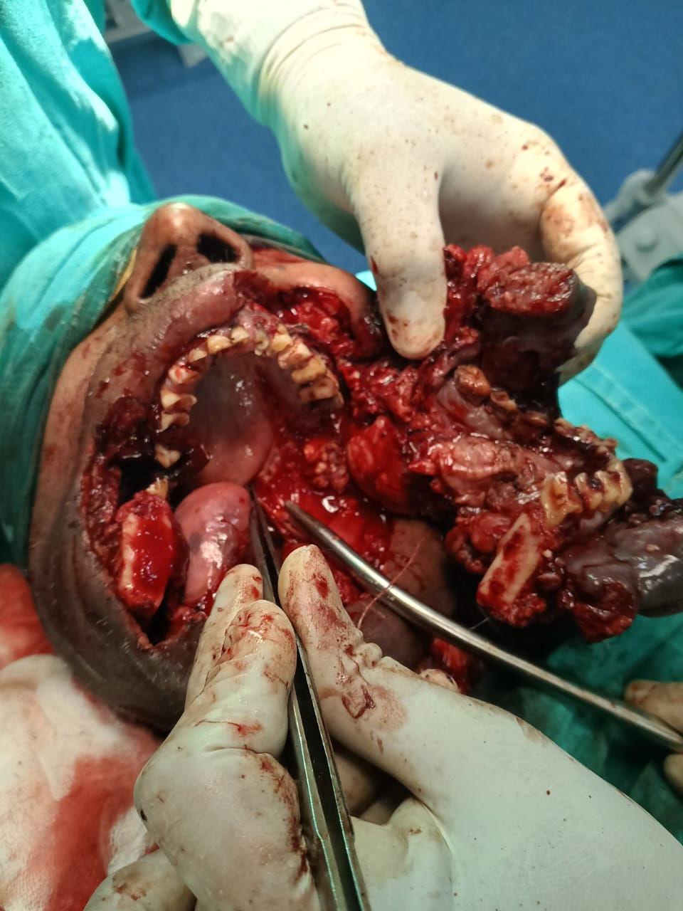 Before Oral Cancer And Reconstructive Surgery