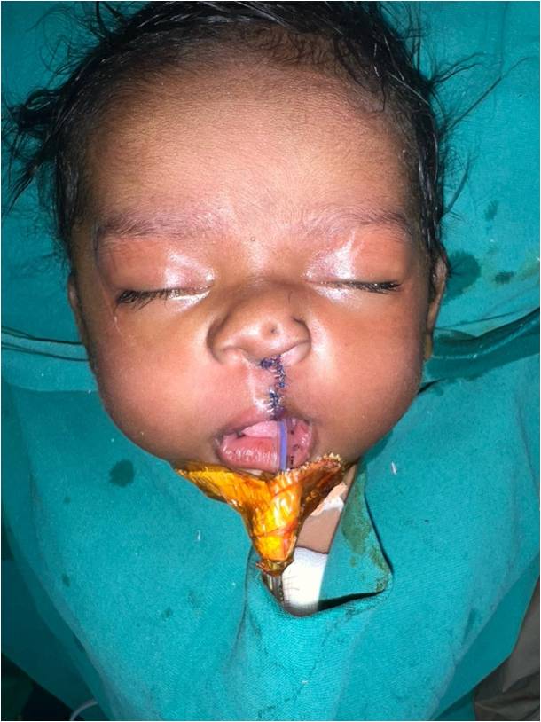 After Unilateral Cleft Lip
