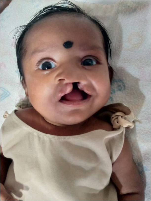 Before Unilateral Cleft Lip