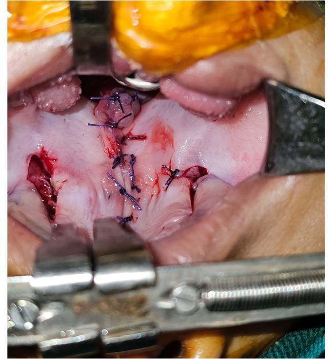 After Veau I Soft Palate Cleft