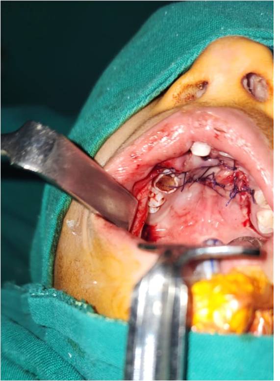 After Type IV Palatal Fistulae