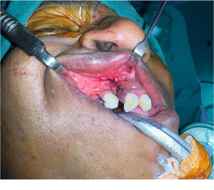 After Secondary Alveolar Bone Grafting