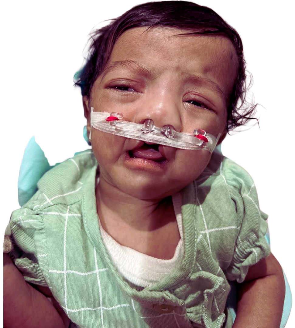 After Naso Alveolar Moulding